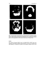 Page 4, hmpao in susp dementia