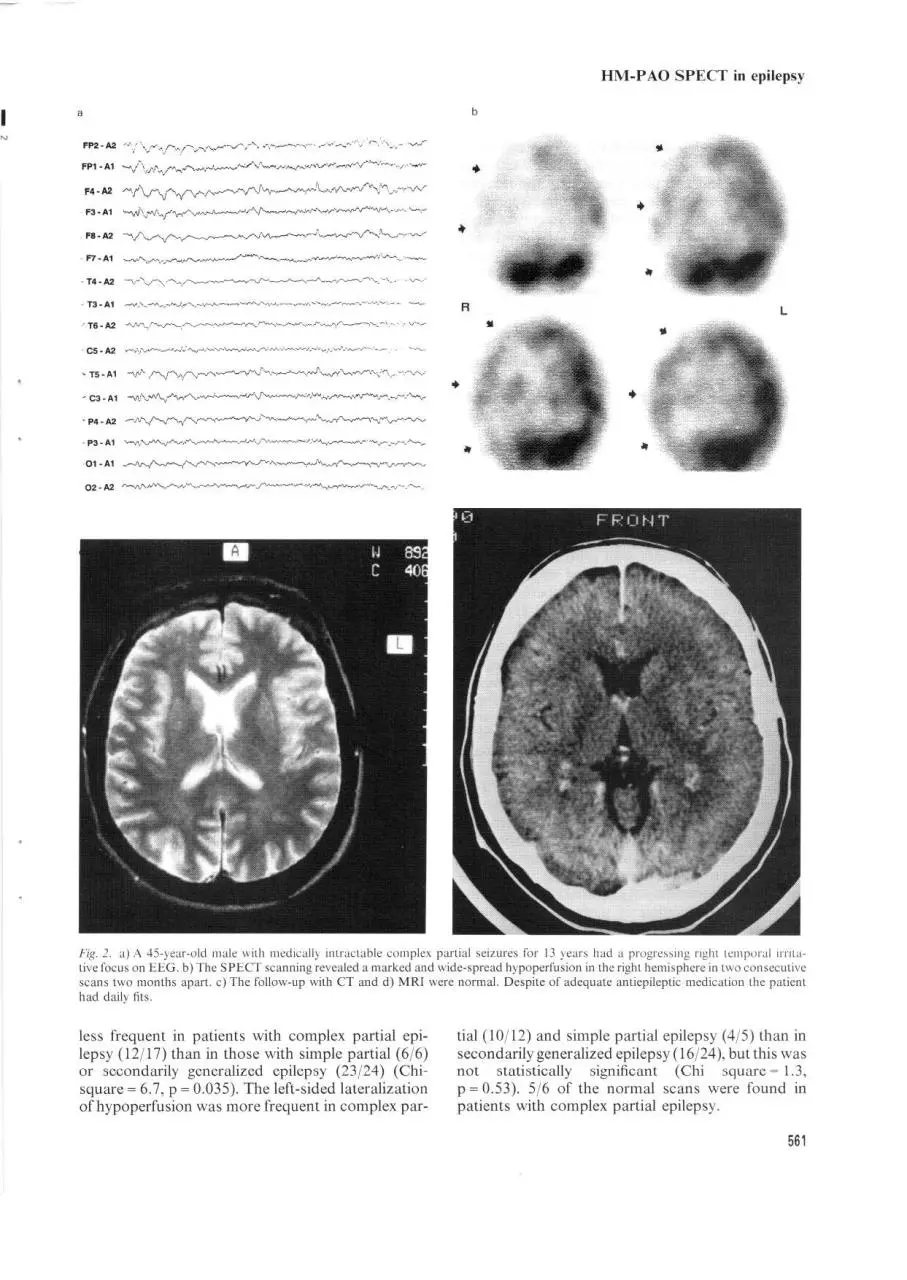 Page 4 of 5, hmpao unstable partial epilepsy