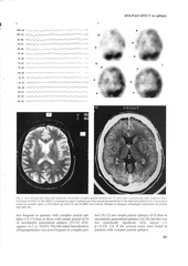 Page 4, hmpao unstable partial epilepsy