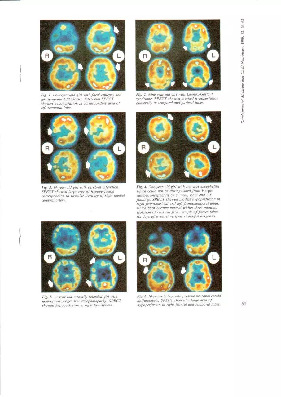 Page 3 of 6, spect in 60 children