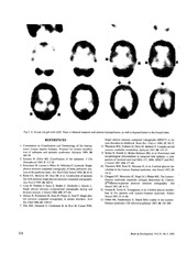 Page 5, spect in clidren with freq fits