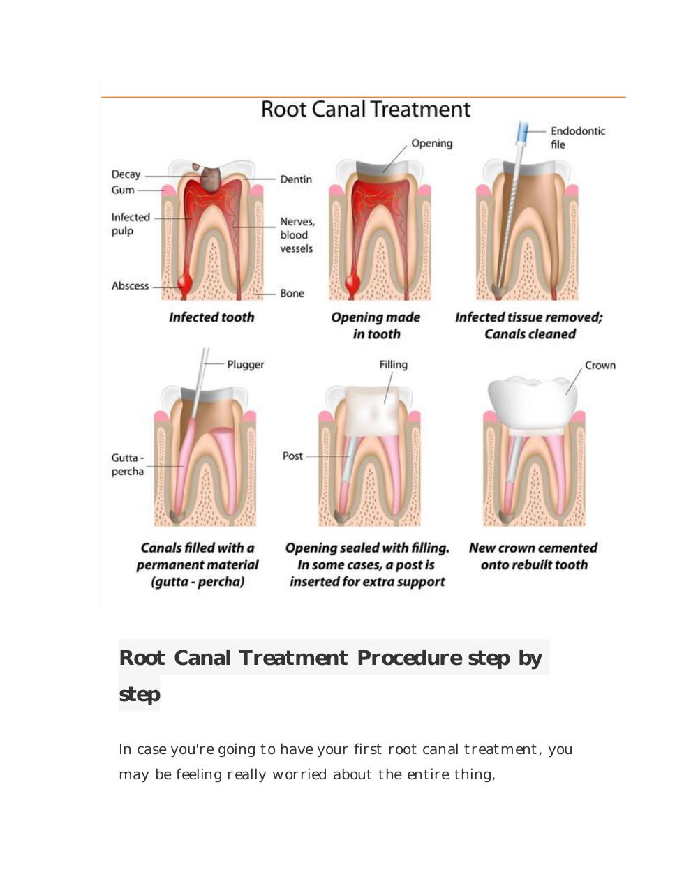 Root Canal Treatment Procedure step by step.pdf - page 1/6