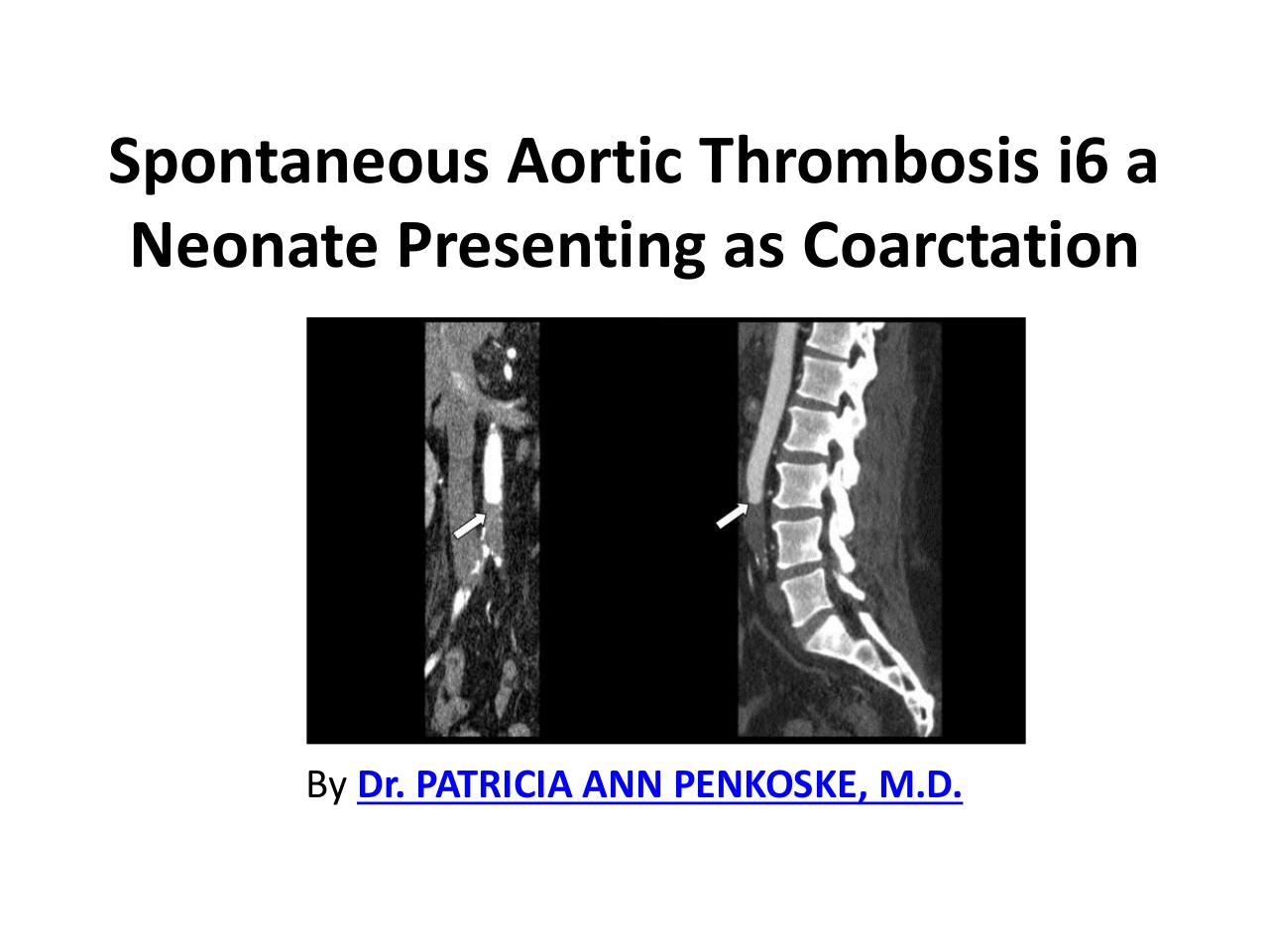 Spontaneous Aortic Thrombosis i6.pdf - page 1/8